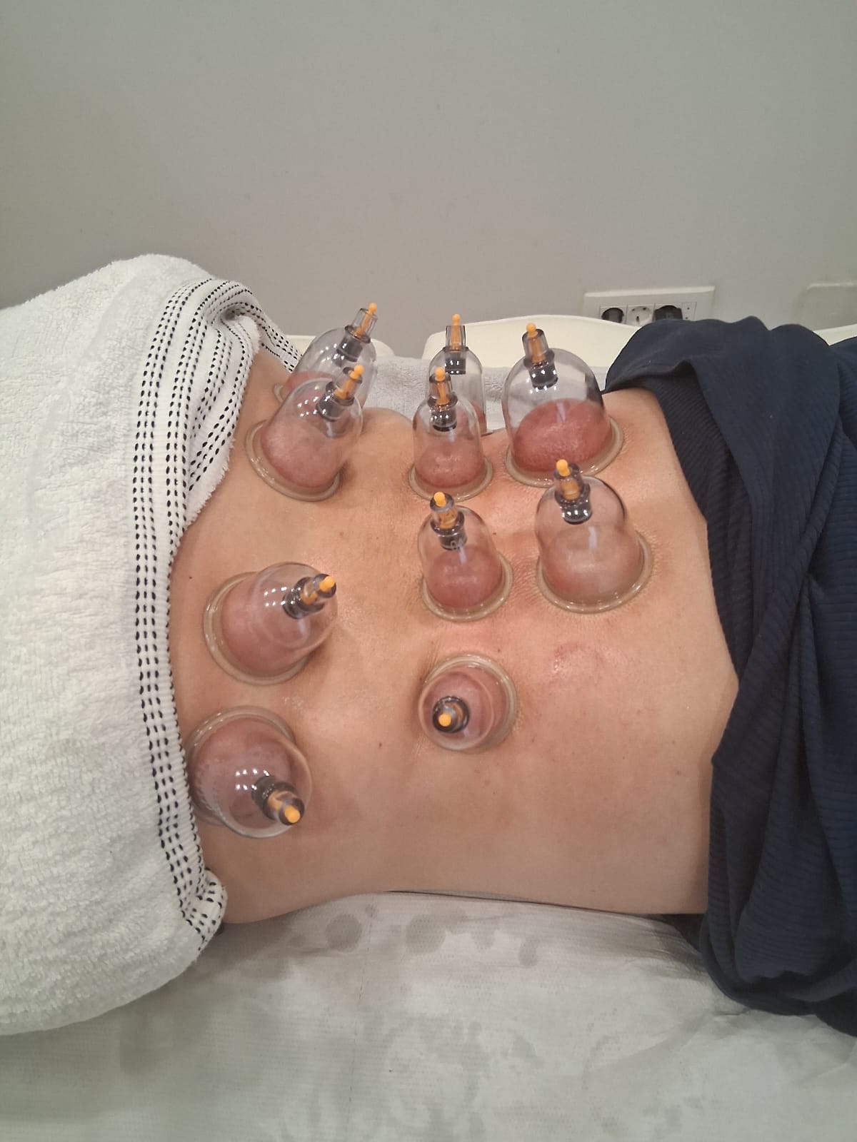 Cupping tretman leđa tijekom usluge u Aura Beauty Studiju